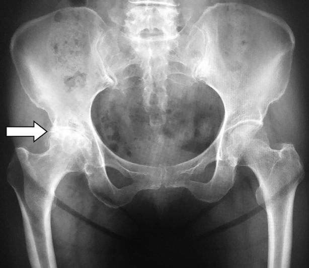 骨のレントゲン画像
